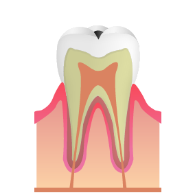 C1：エナメル質部分のむし歯