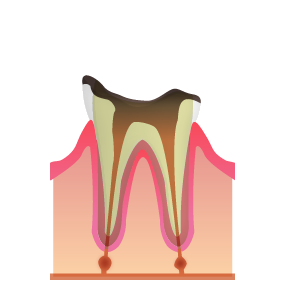 C4：歯根まで達したむし歯