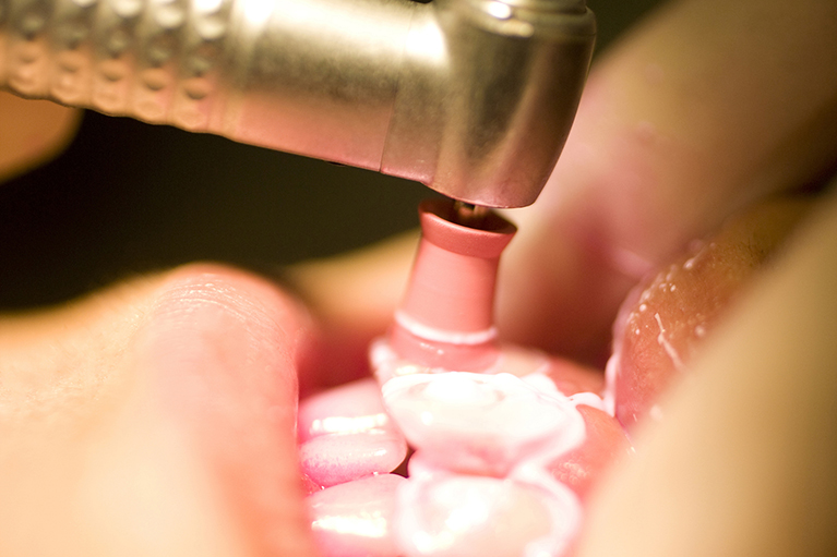 むし歯・歯周病の予防にクリーニング（PMTC）